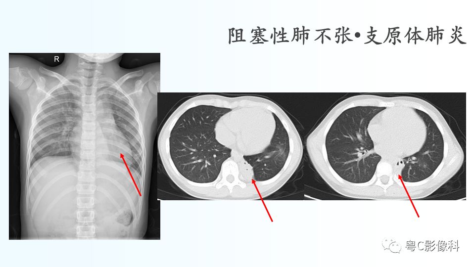 【PPT】儿童胸部影像诊断*基础病变