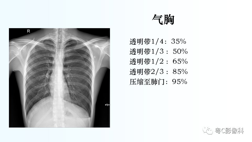 【PPT】儿童胸部影像诊断*基础病变