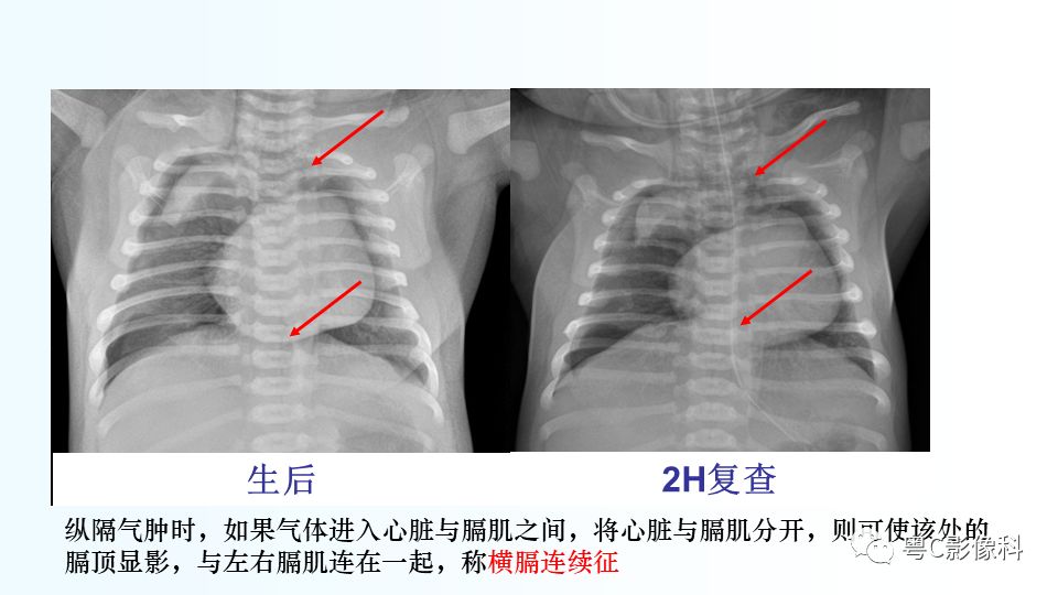 【PPT】儿童胸部影像诊断*基础病变