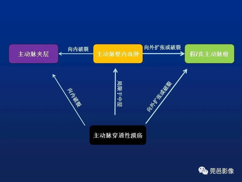【PPT】急性主动脉综合征