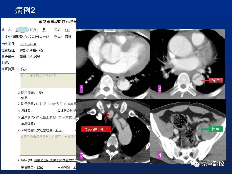 【PPT】急性主动脉综合征