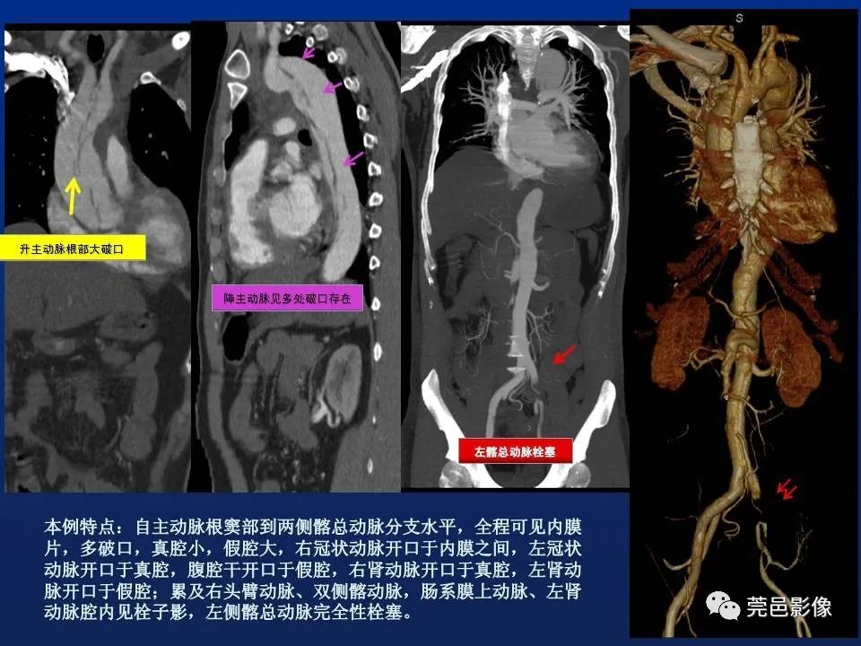 【PPT】急性主动脉综合征