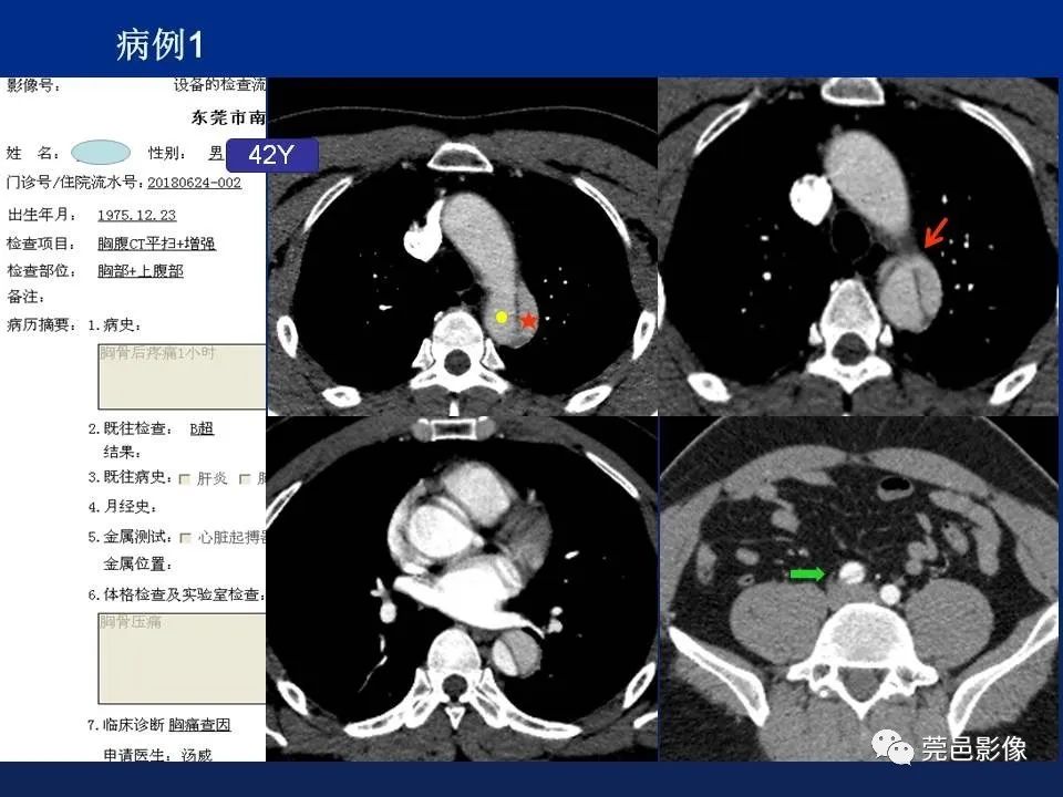 【PPT】急性主动脉综合征