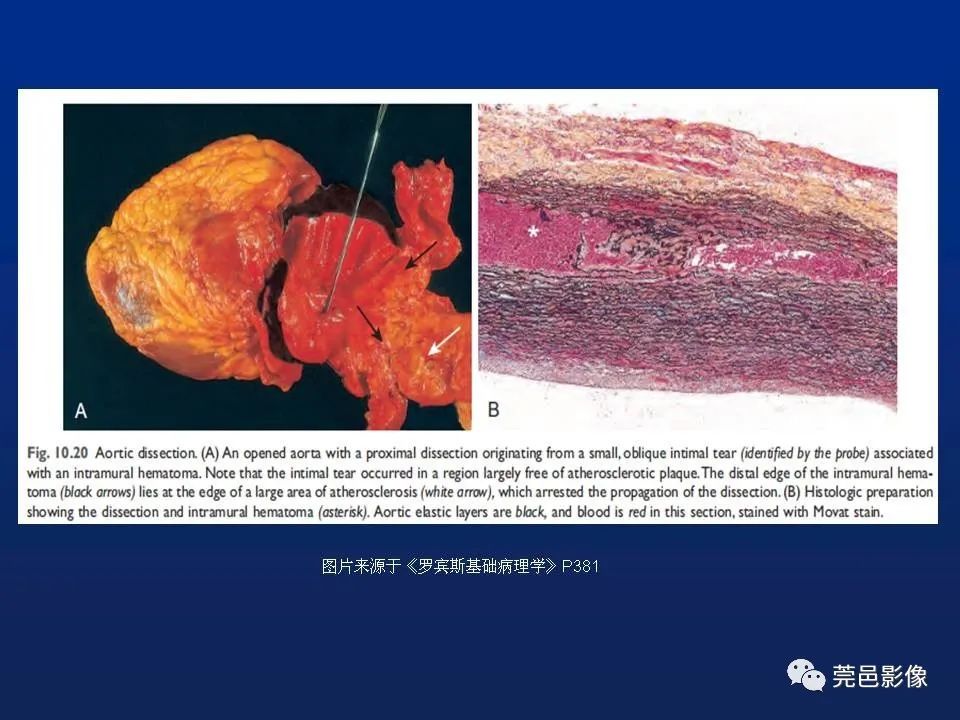 【PPT】急性主动脉综合征
