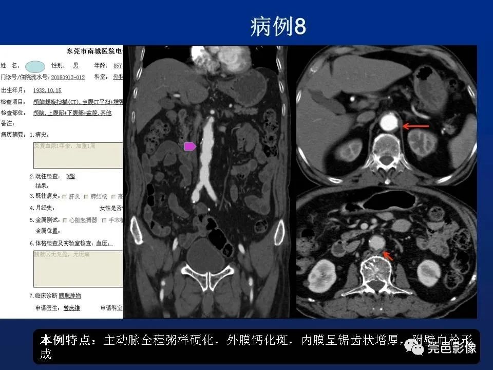 【PPT】急性主动脉综合征