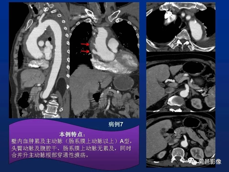 【PPT】急性主动脉综合征