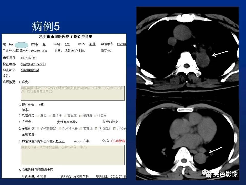 【PPT】急性主动脉综合征