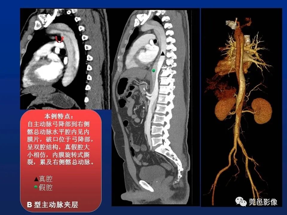 【PPT】急性主动脉综合征