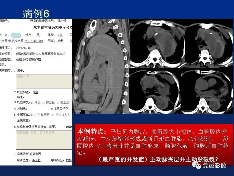 【PPT】急性主动脉综合征