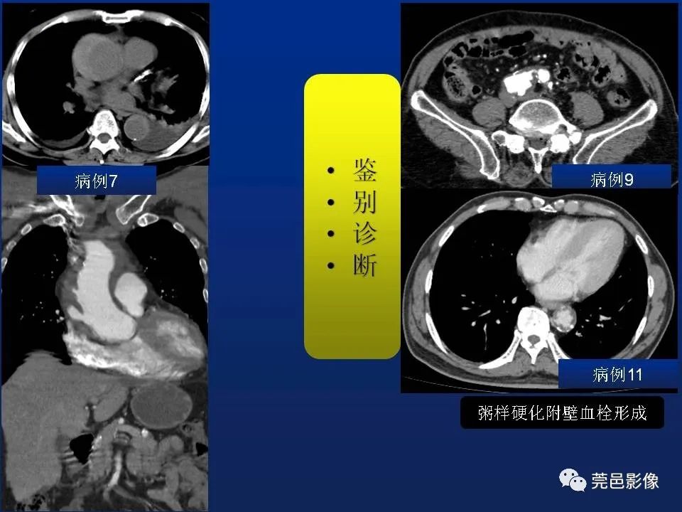【PPT】急性主动脉综合征