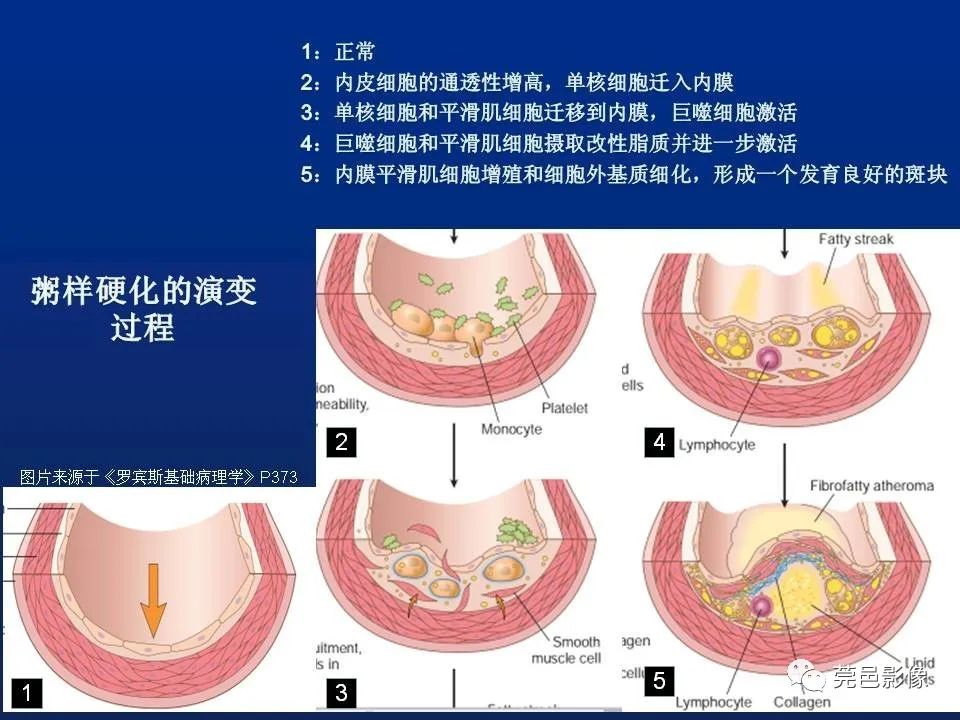【PPT】急性主动脉综合征