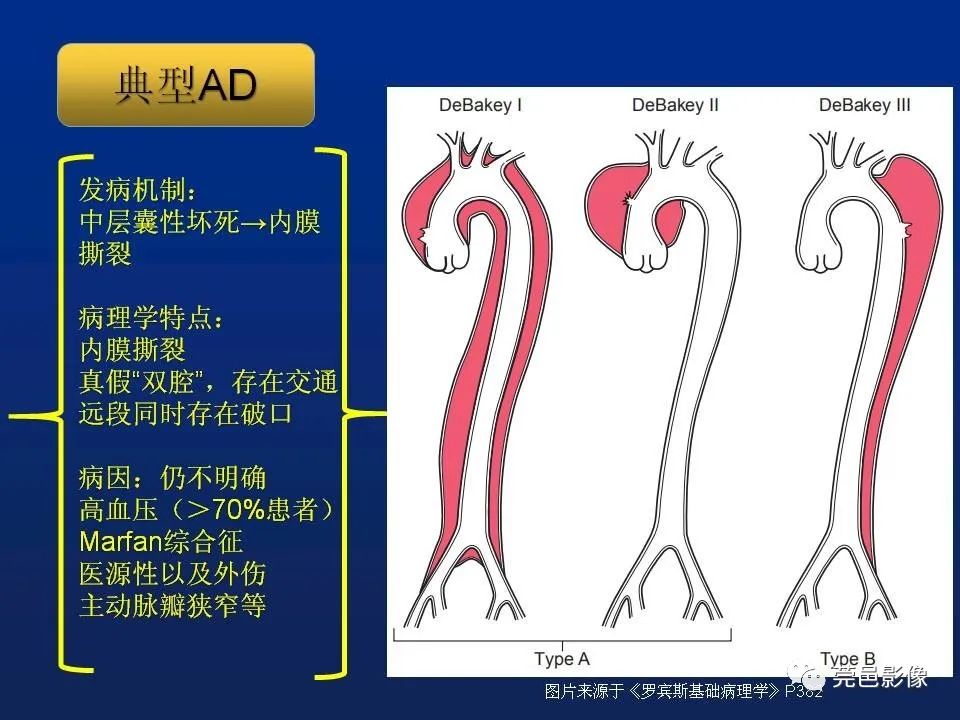 【PPT】急性主动脉综合征