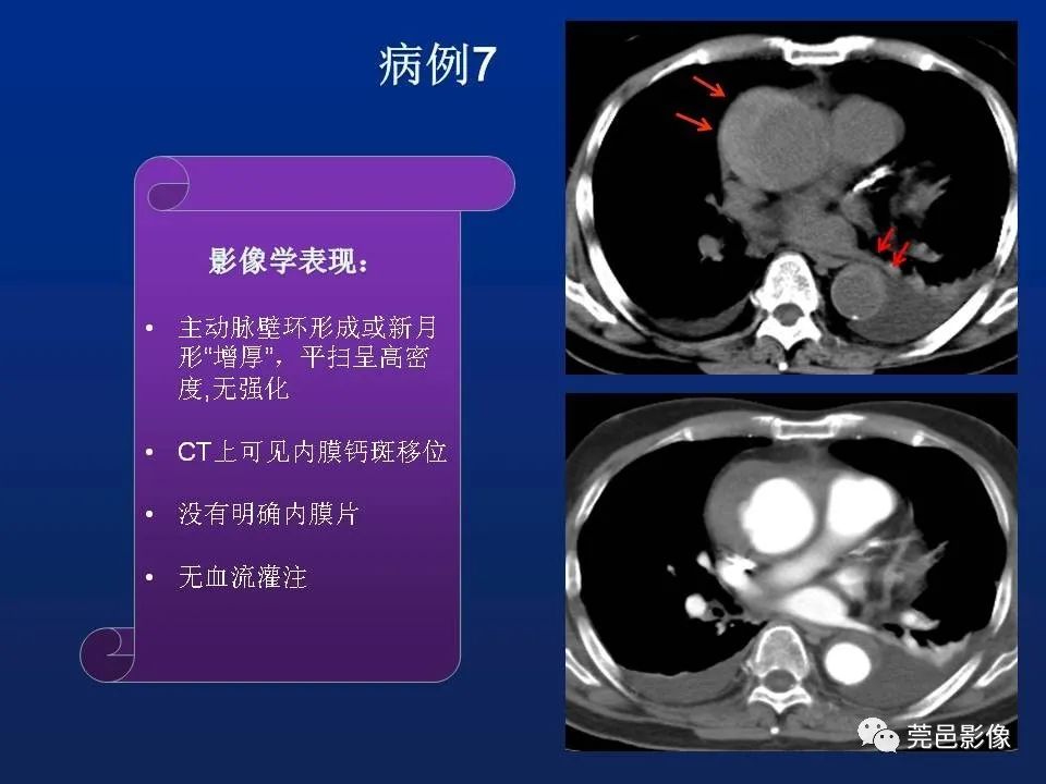 【PPT】急性主动脉综合征