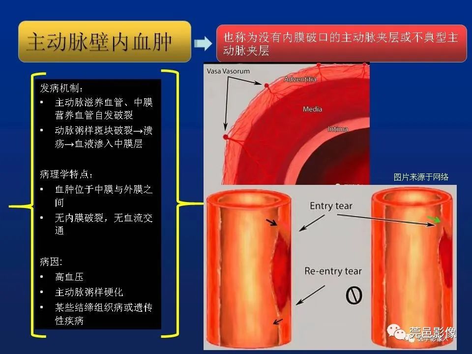 【PPT】急性主动脉综合征