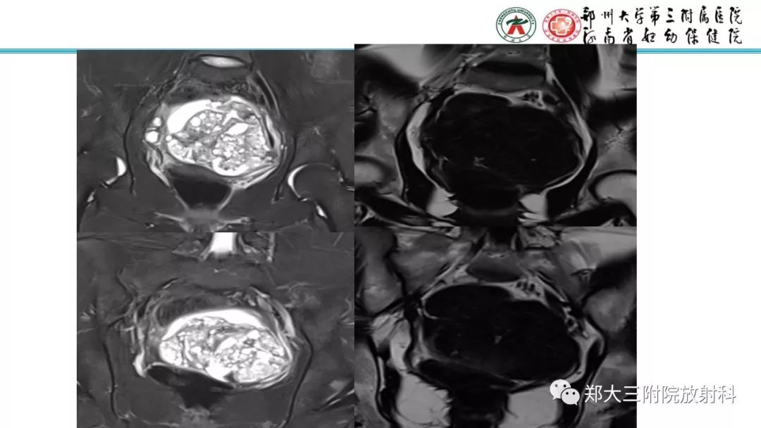 【病例】卵巢未成熟畸胎瘤1例MR影像 【病例】卵巢未成熟畸胎瘤1例MR影像