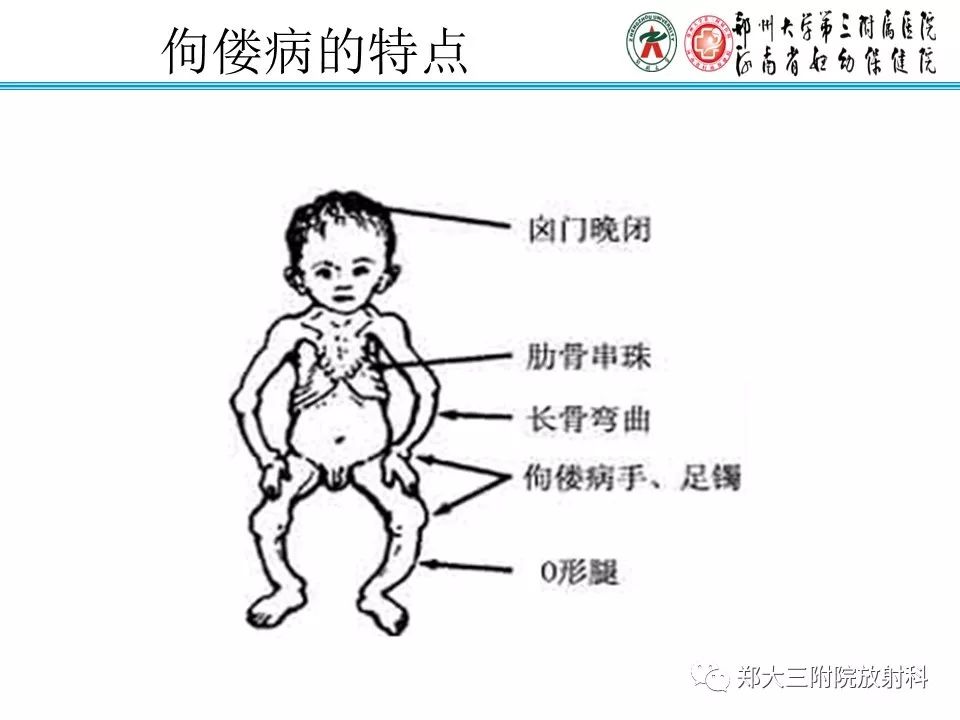 【PPT】佝偻病的影像特点