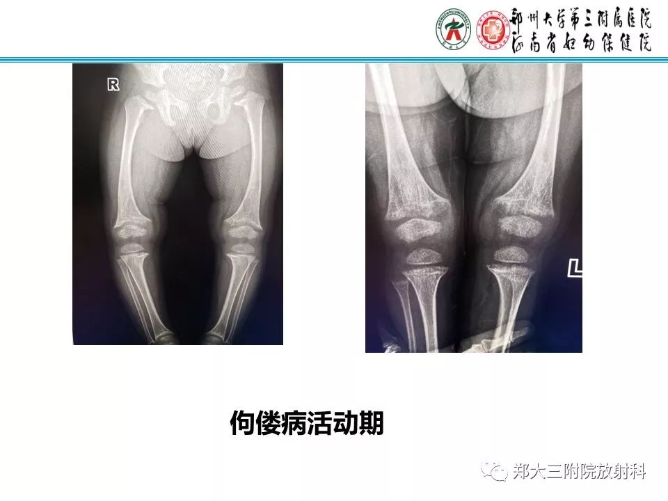 【PPT】佝偻病的影像特点