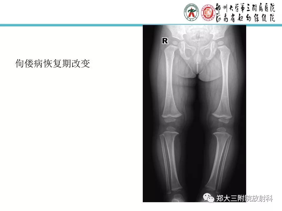 【PPT】佝偻病的影像特点