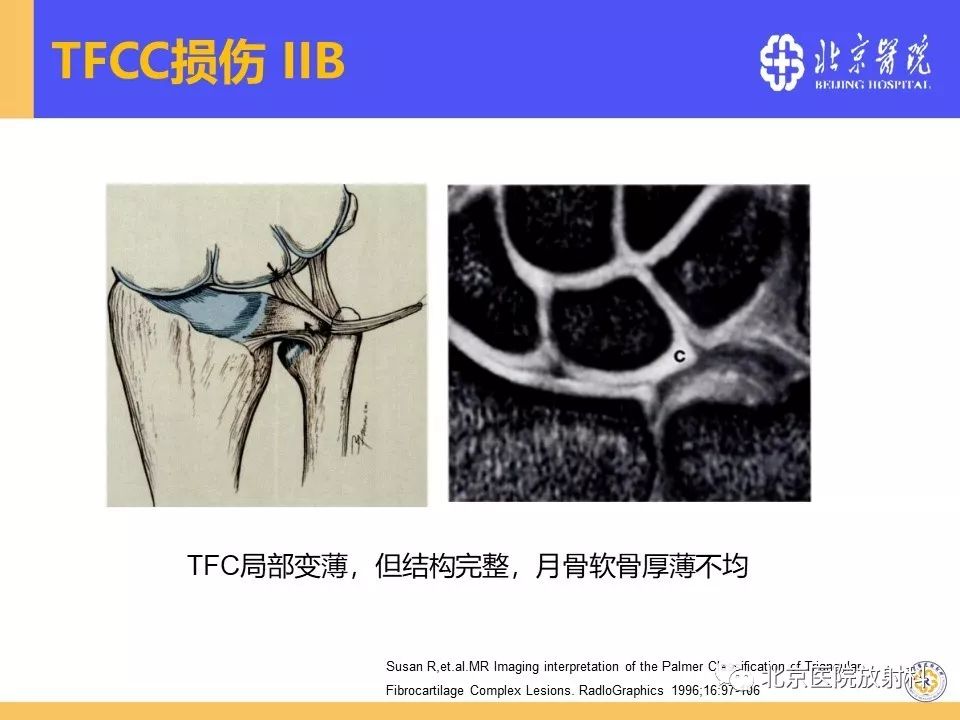 【PPT】三角纤维软骨复合体(TFCC)损伤 【PPT】三角纤维软骨复合体(TFCC)损伤