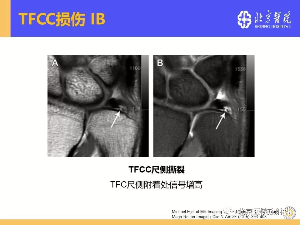 【PPT】三角纤维软骨复合体(TFCC)损伤 【PPT】三角纤维软骨复合体(TFCC)损伤