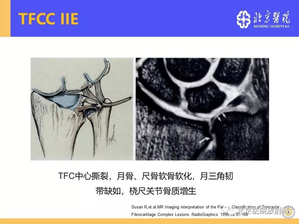 【PPT】三角纤维软骨复合体(TFCC)损伤 【PPT】三角纤维软骨复合体(TFCC)损伤