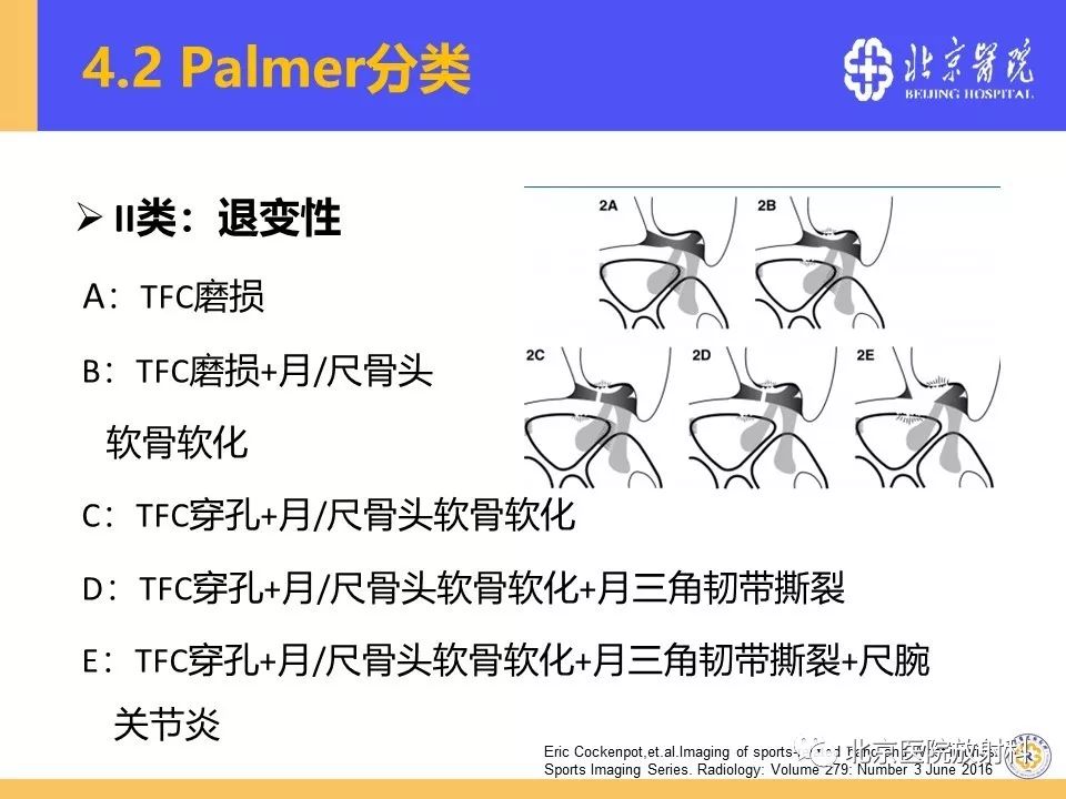 【PPT】三角纤维软骨复合体(TFCC)损伤 【PPT】三角纤维软骨复合体(TFCC)损伤