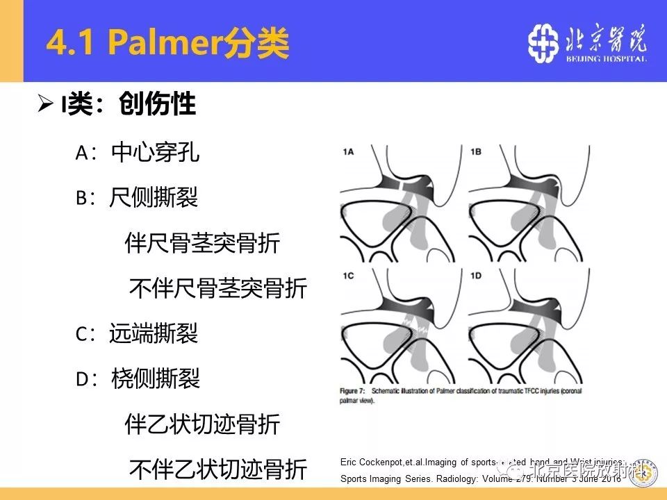 【PPT】三角纤维软骨复合体(TFCC)损伤 【PPT】三角纤维软骨复合体(TFCC)损伤