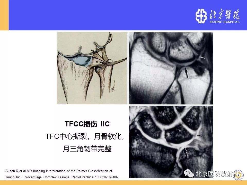 【PPT】三角纤维软骨复合体(TFCC)损伤 【PPT】三角纤维软骨复合体(TFCC)损伤