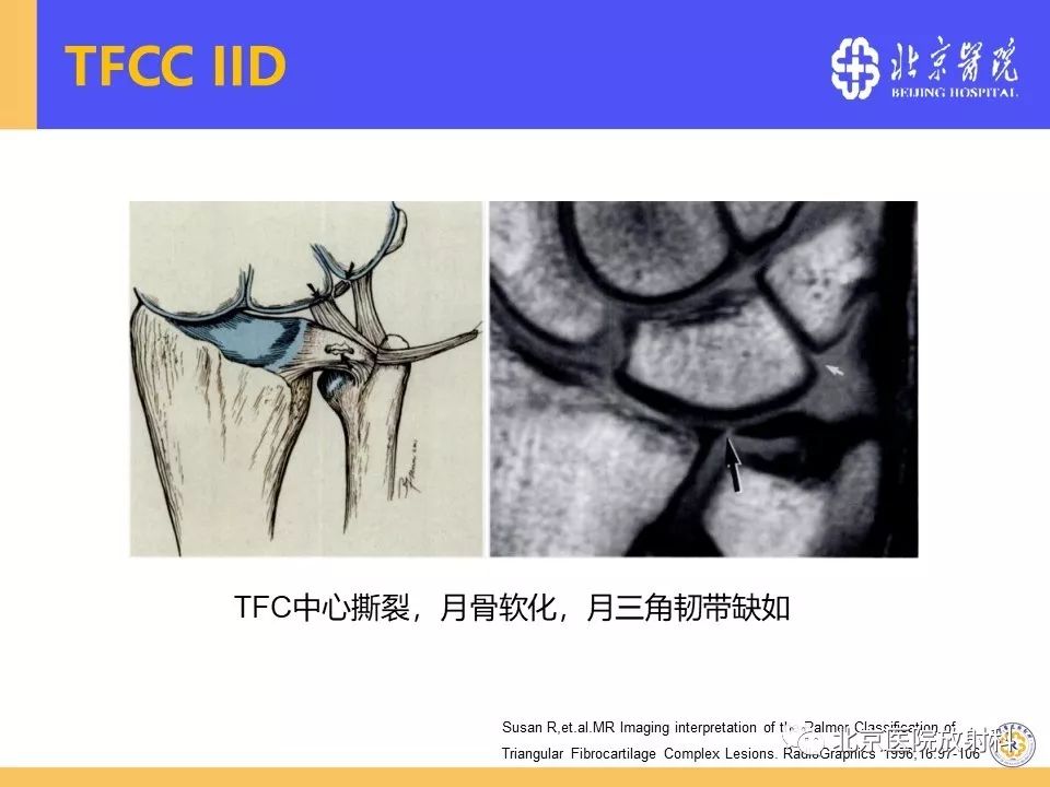 【PPT】三角纤维软骨复合体(TFCC)损伤 【PPT】三角纤维软骨复合体(TFCC)损伤