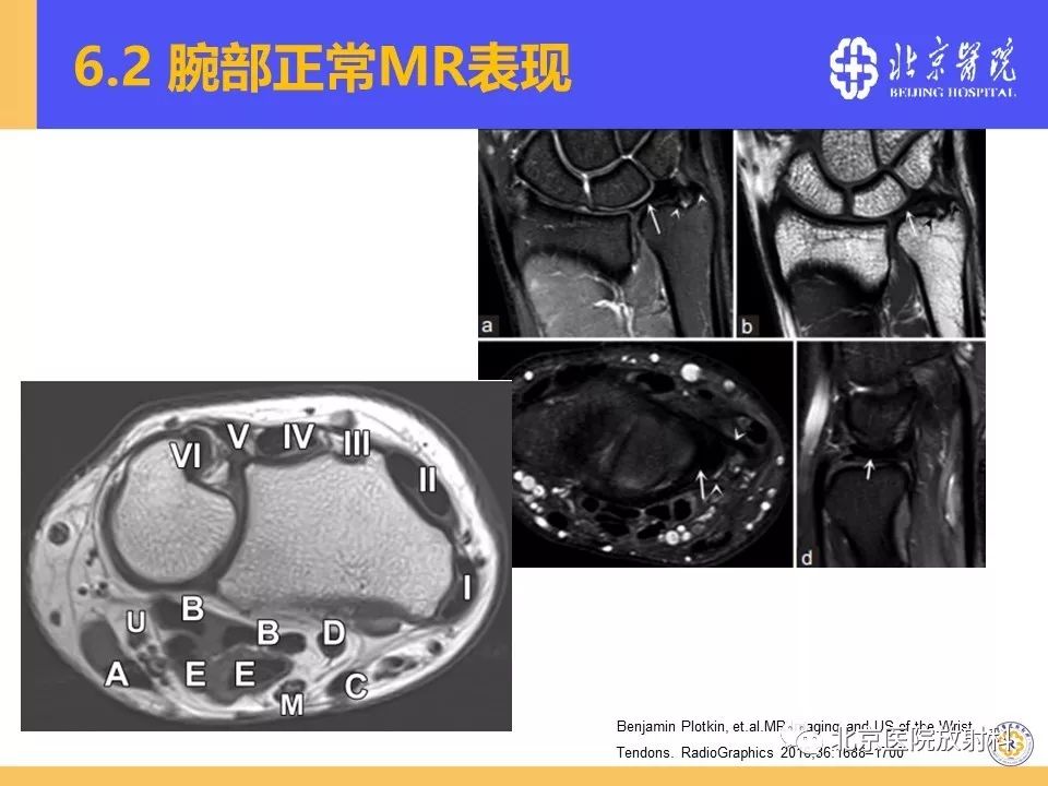 【PPT】三角纤维软骨复合体(TFCC)损伤 【PPT】三角纤维软骨复合体(TFCC)损伤