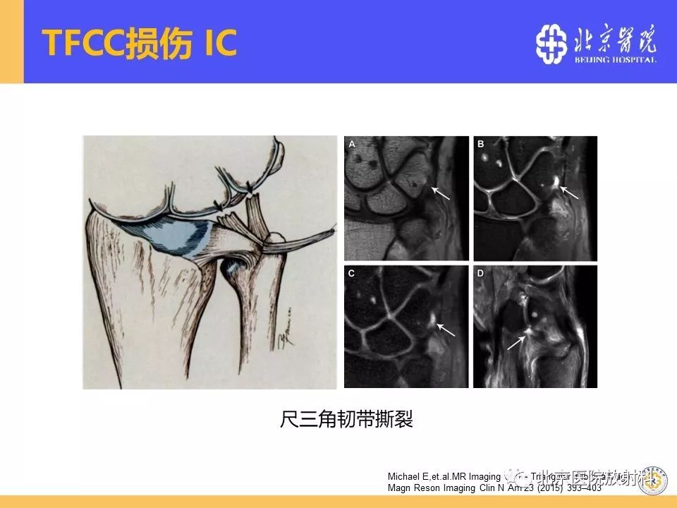 【PPT】三角纤维软骨复合体(TFCC)损伤 【PPT】三角纤维软骨复合体(TFCC)损伤