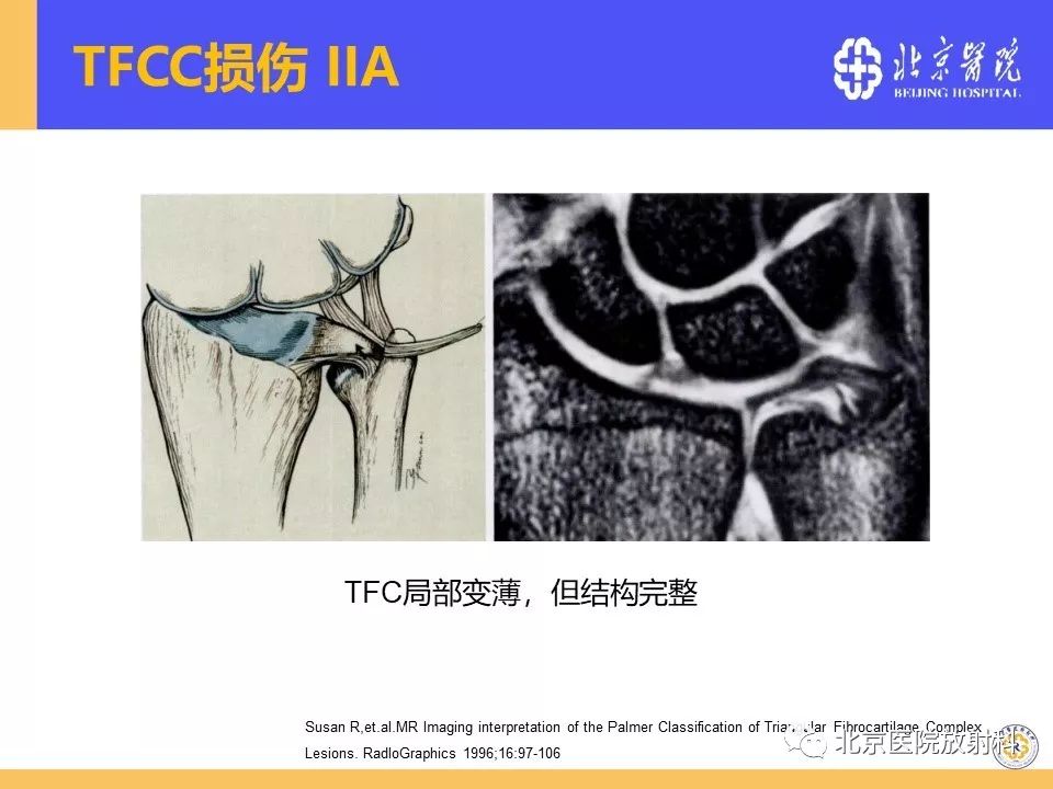 【PPT】三角纤维软骨复合体(TFCC)损伤 【PPT】三角纤维软骨复合体(TFCC)损伤