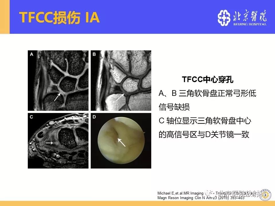 【PPT】三角纤维软骨复合体(TFCC)损伤 【PPT】三角纤维软骨复合体(TFCC)损伤