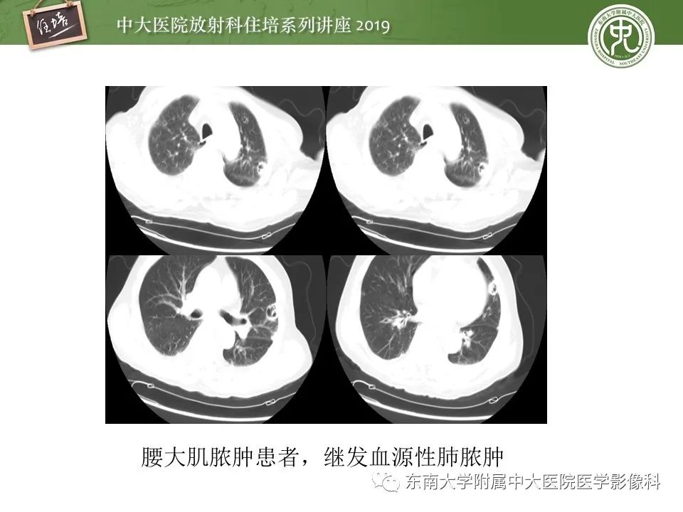 【PPT】肺空洞病变影像诊断及鉴别