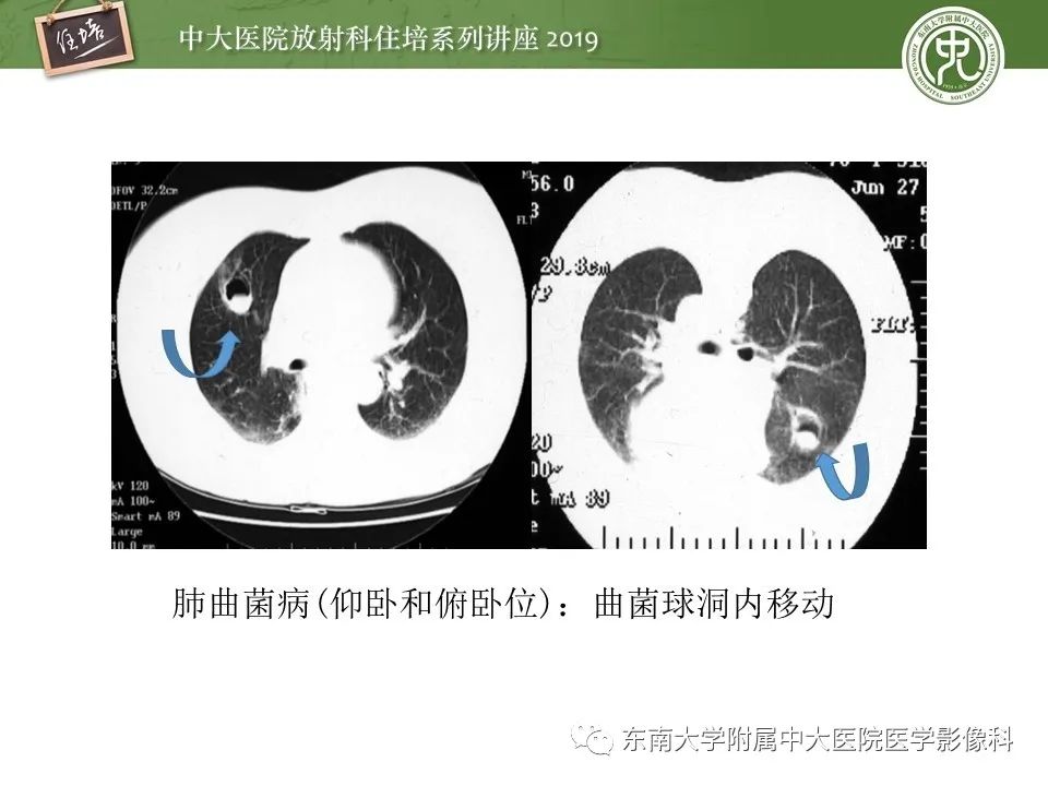 【PPT】肺空洞病变影像诊断及鉴别