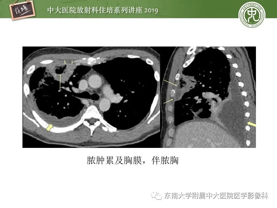【PPT】肺空洞病变影像诊断及鉴别