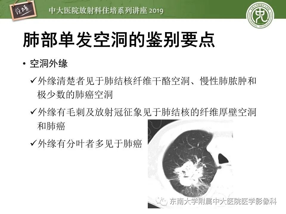 【PPT】肺空洞病变影像诊断及鉴别