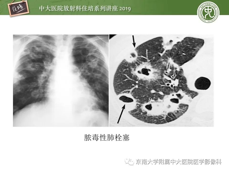 【PPT】肺空洞病变影像诊断及鉴别