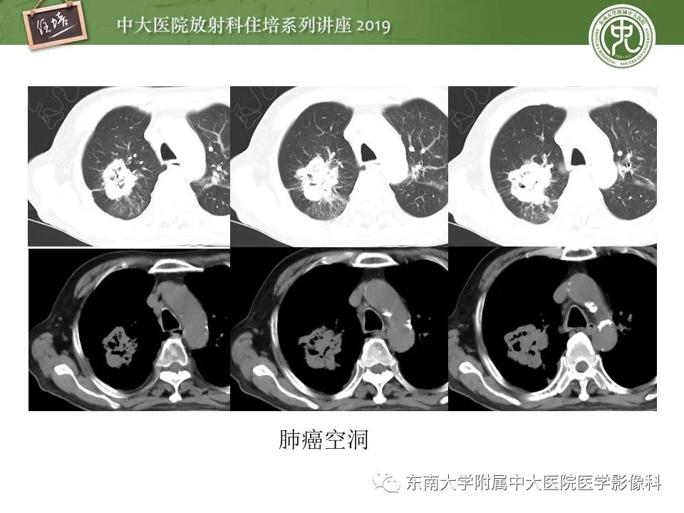 【PPT】肺空洞病变影像诊断及鉴别