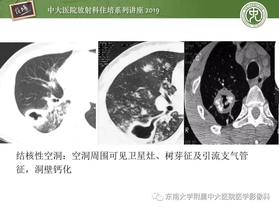 【PPT】肺空洞病变影像诊断及鉴别