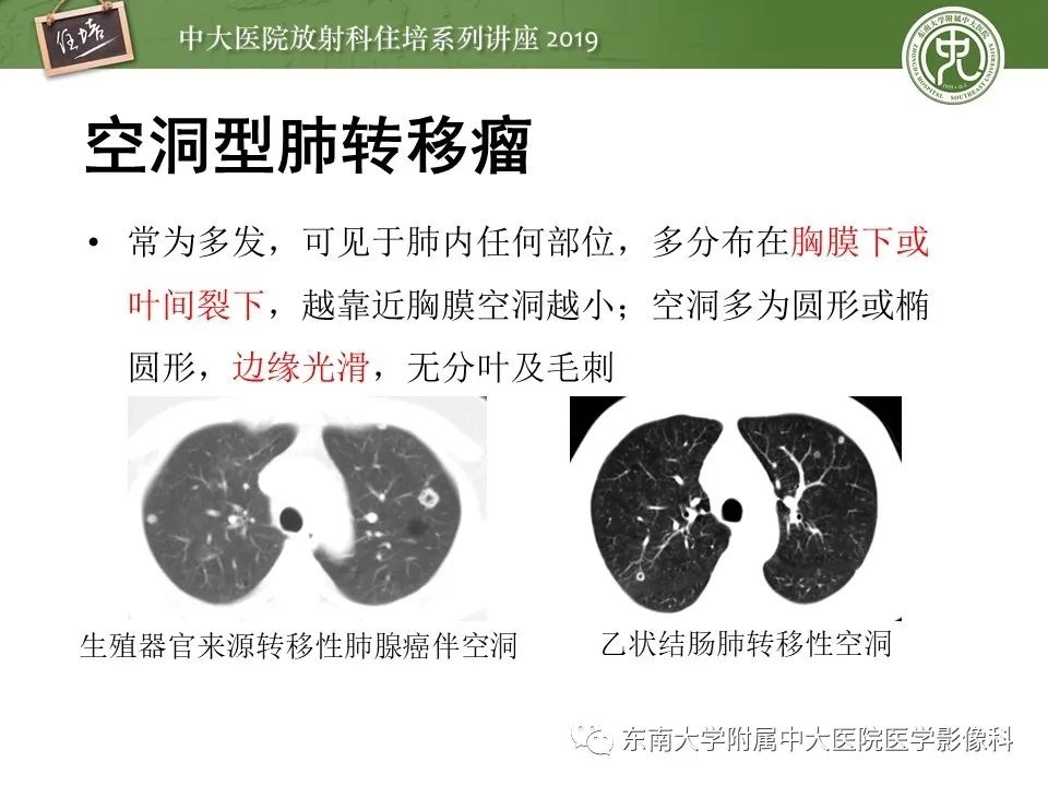 【PPT】肺空洞病变影像诊断及鉴别