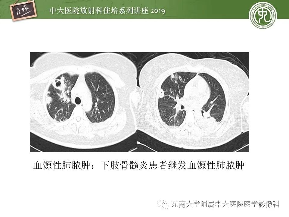 【PPT】肺空洞病变影像诊断及鉴别