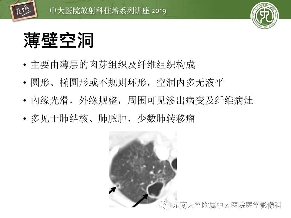【PPT】肺空洞病变影像诊断及鉴别