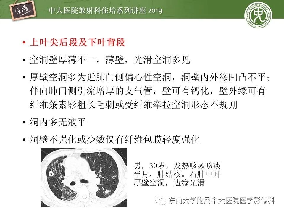 【PPT】肺空洞病变影像诊断及鉴别
