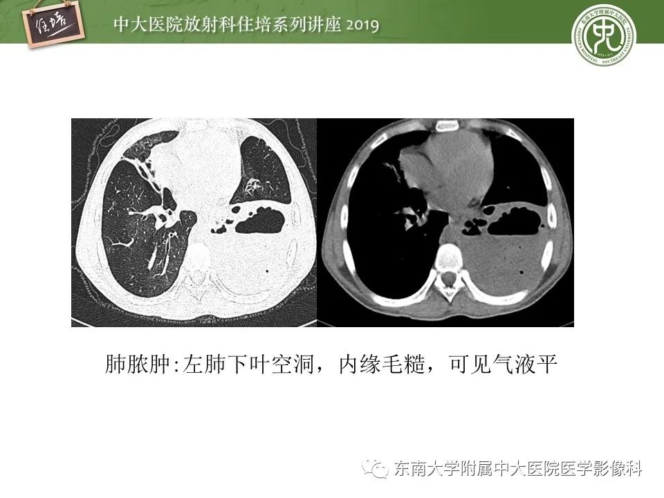 【PPT】肺空洞病变影像诊断及鉴别