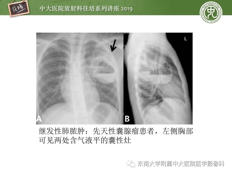 【PPT】肺空洞病变影像诊断及鉴别