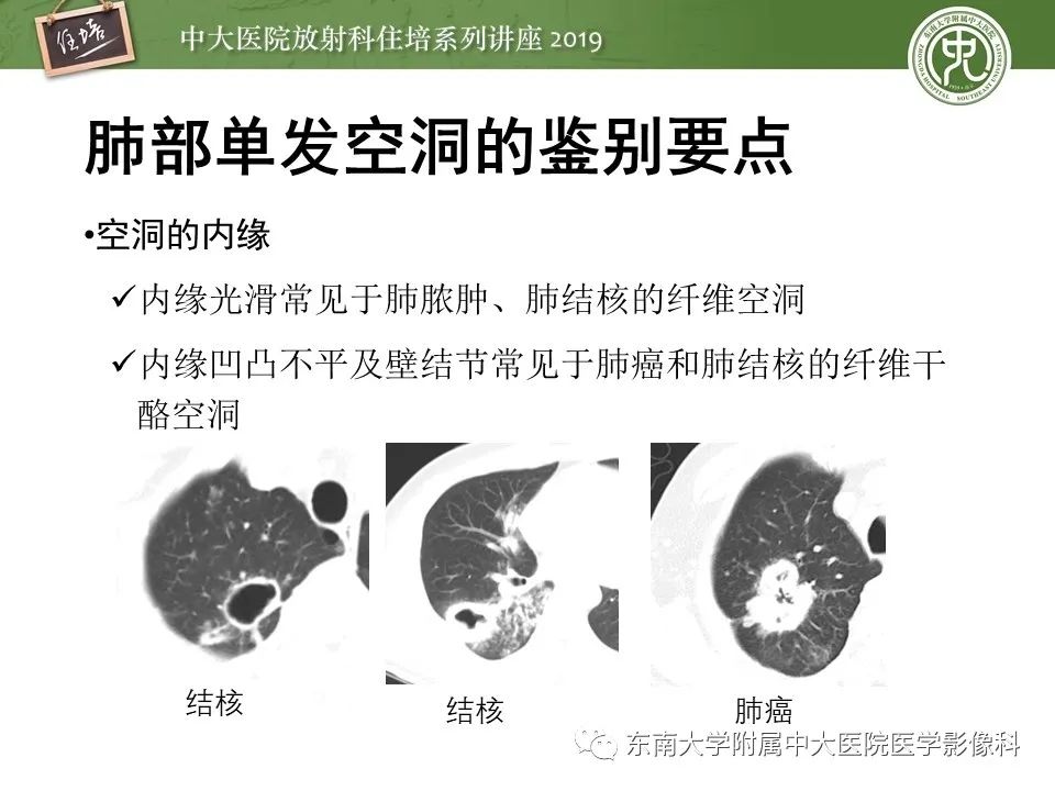 【PPT】肺空洞病变影像诊断及鉴别