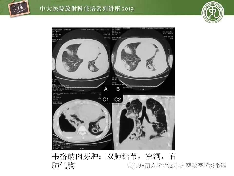 【PPT】肺空洞病变影像诊断及鉴别