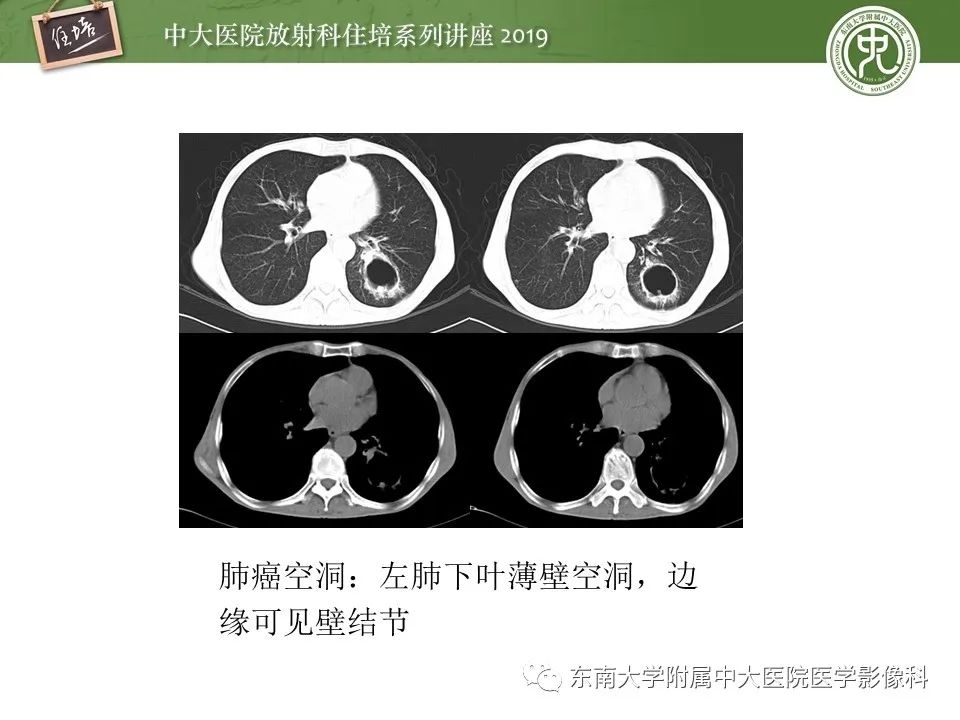 【PPT】肺空洞病变影像诊断及鉴别