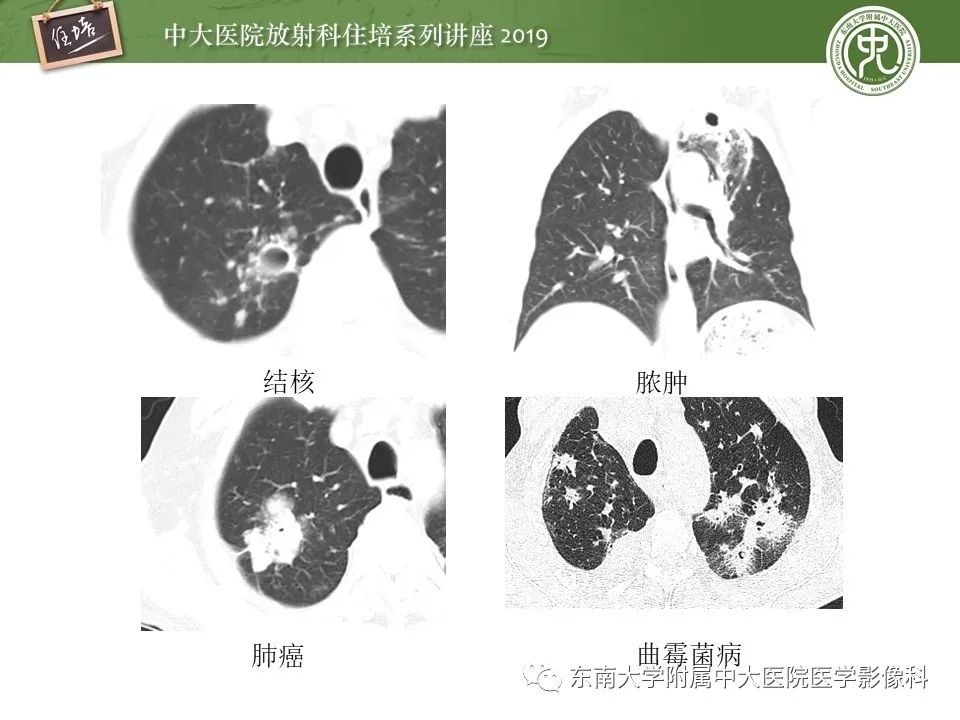 【PPT】肺空洞病变影像诊断及鉴别